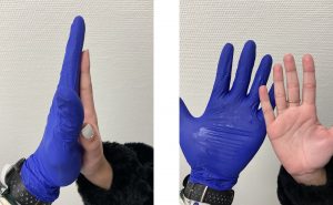 Hiperhidrosis palmar