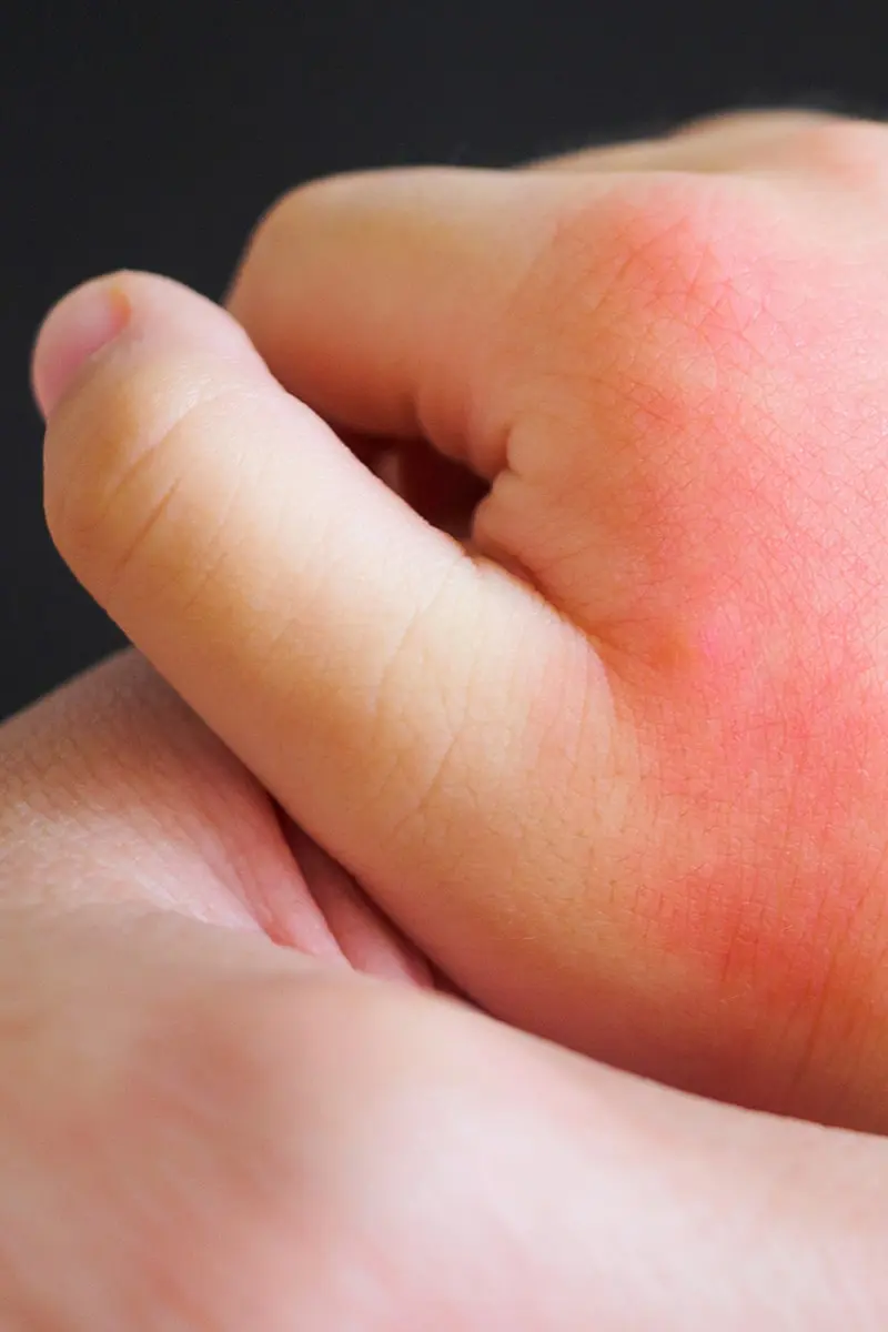 Dermatología Infantil Madrid