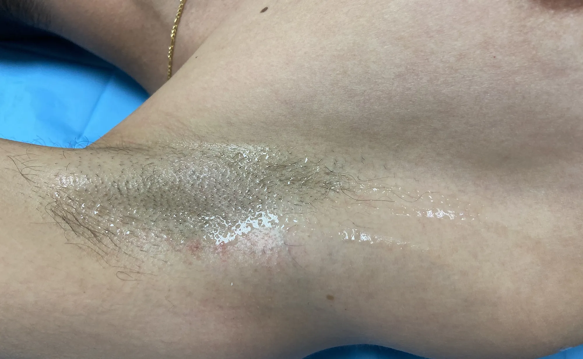 Hiperhidrosis Manos Tratamiento